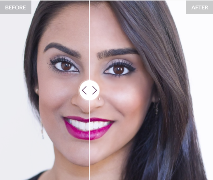 juvederm visualizer